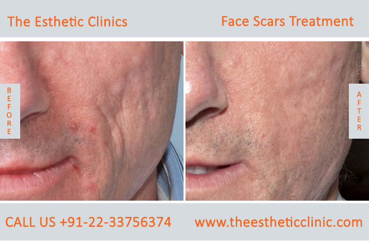 Face Scar Removal Laser Treatment before after photos in mumbai india (1)